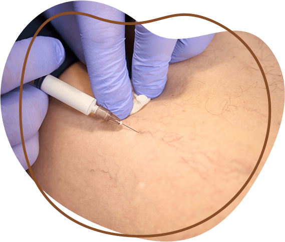 PRP treatment for scar removal
