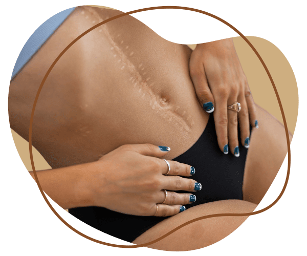 Stretch Marks Removal by Advanced Technique