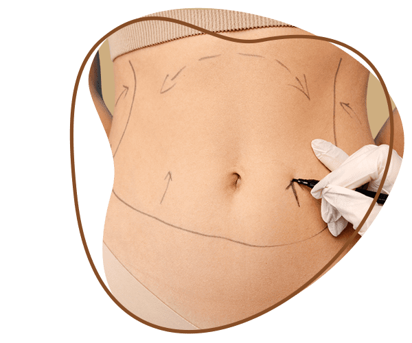 Tummy Tuck Surgery