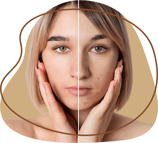 Acne scar removal