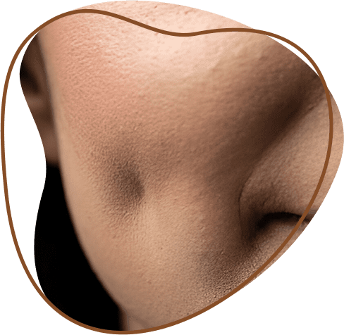 Facial dimple creation surgery