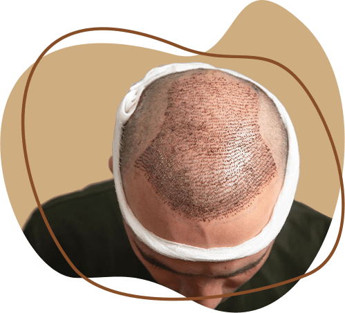 hair transplant
