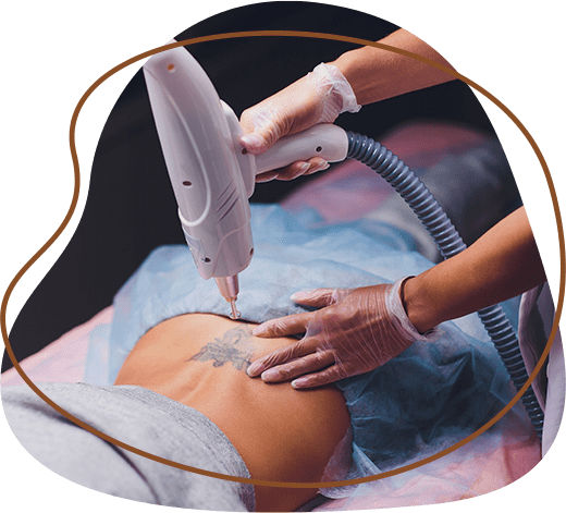 Mesotherapy Tattoo removal