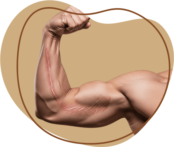 stretch marks men