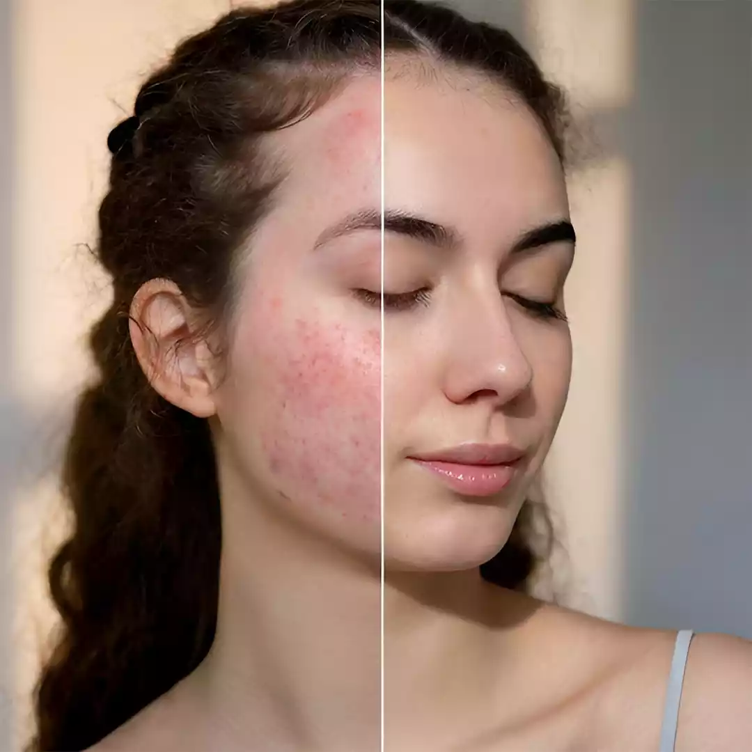Acne Scar Treatment