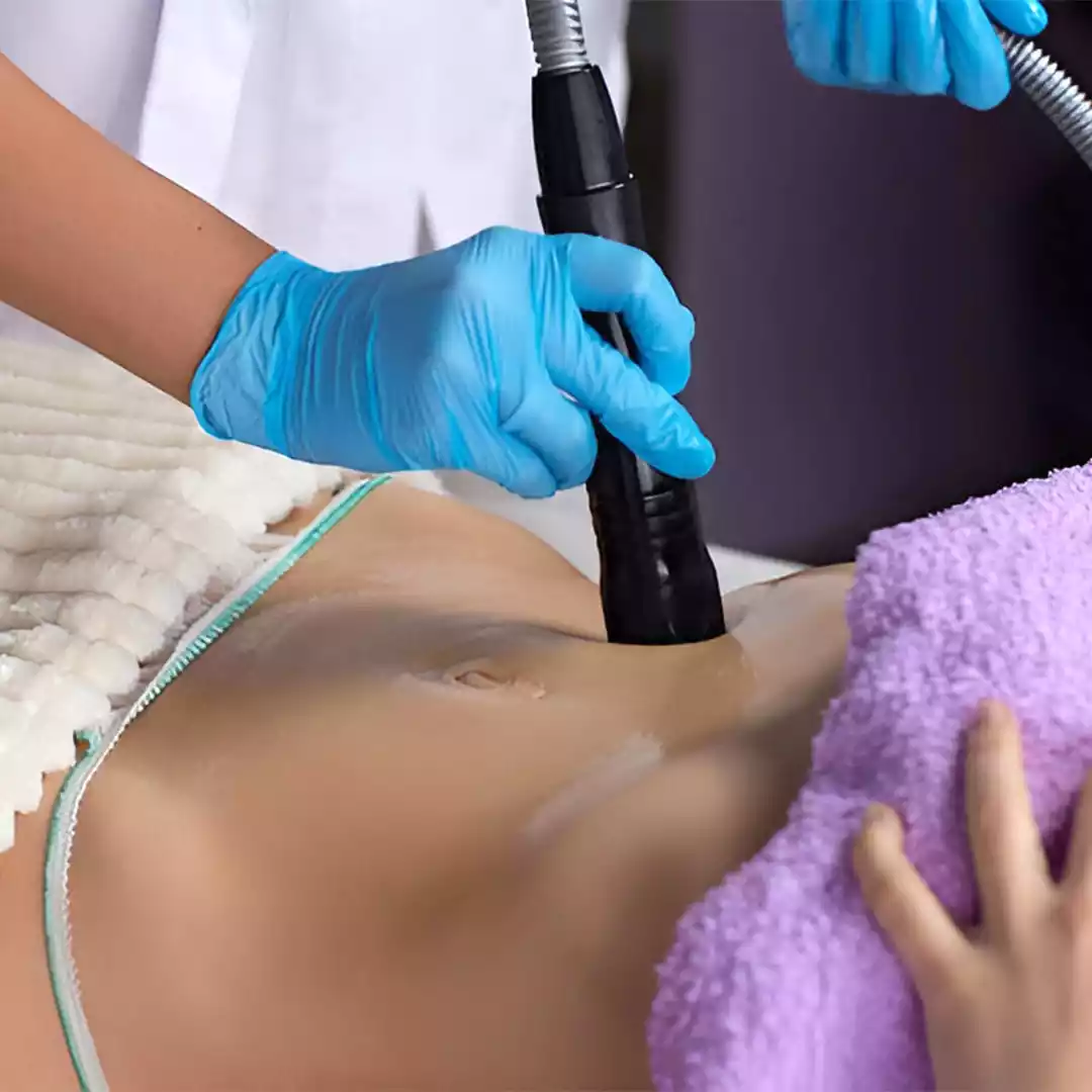 Cavitation