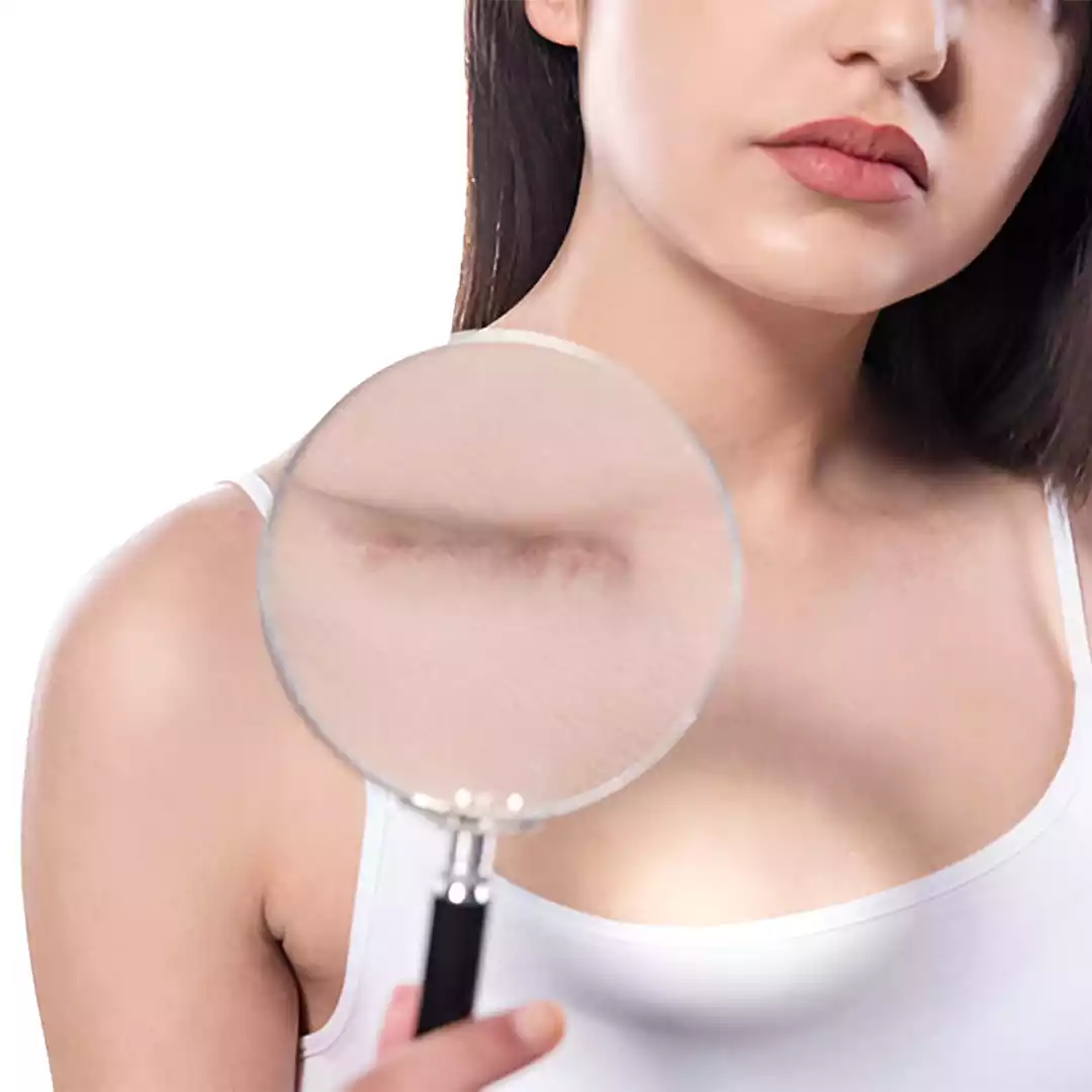 Scar Removal