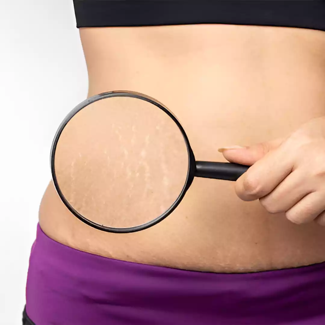 Stretch Mark Reduction