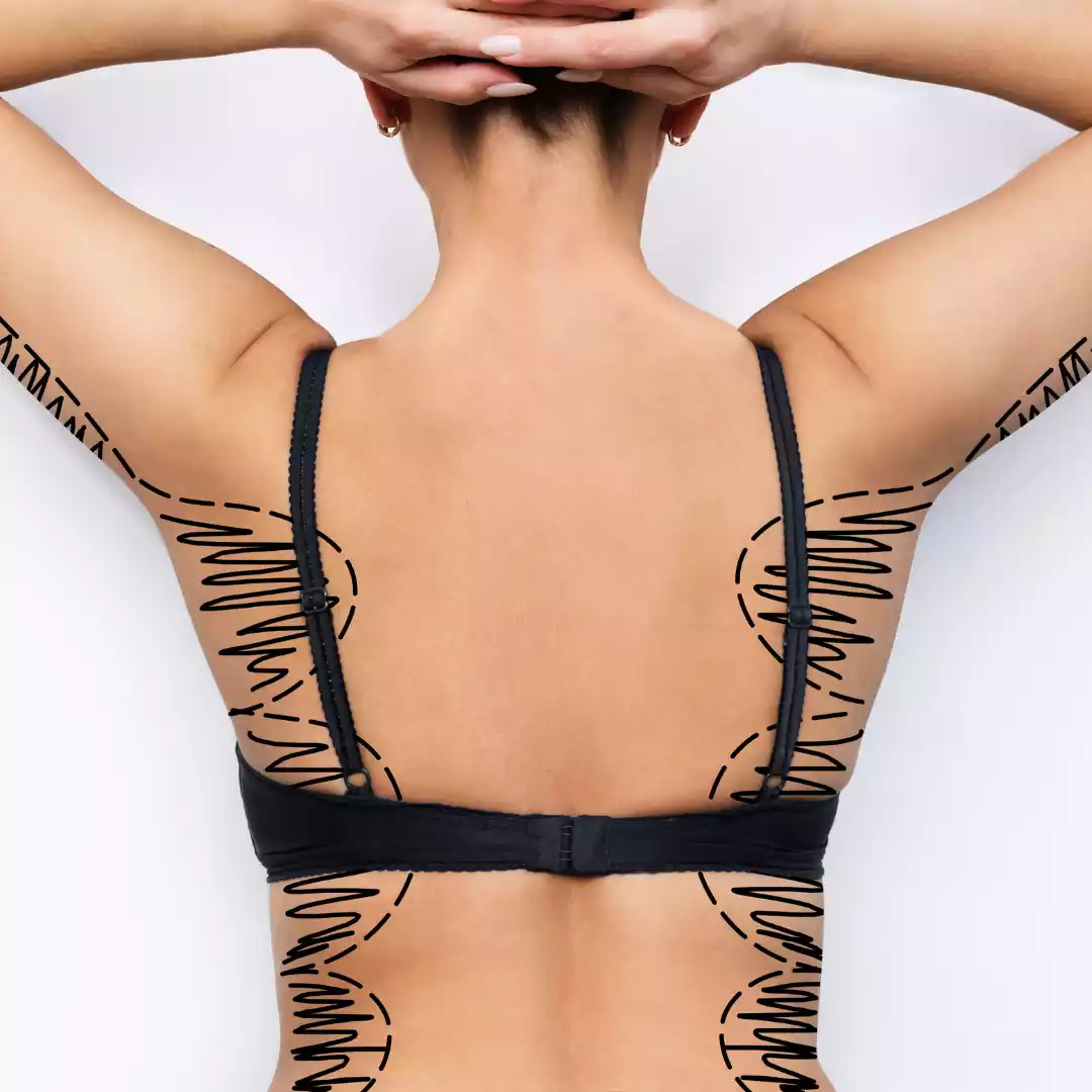 Back Contouring