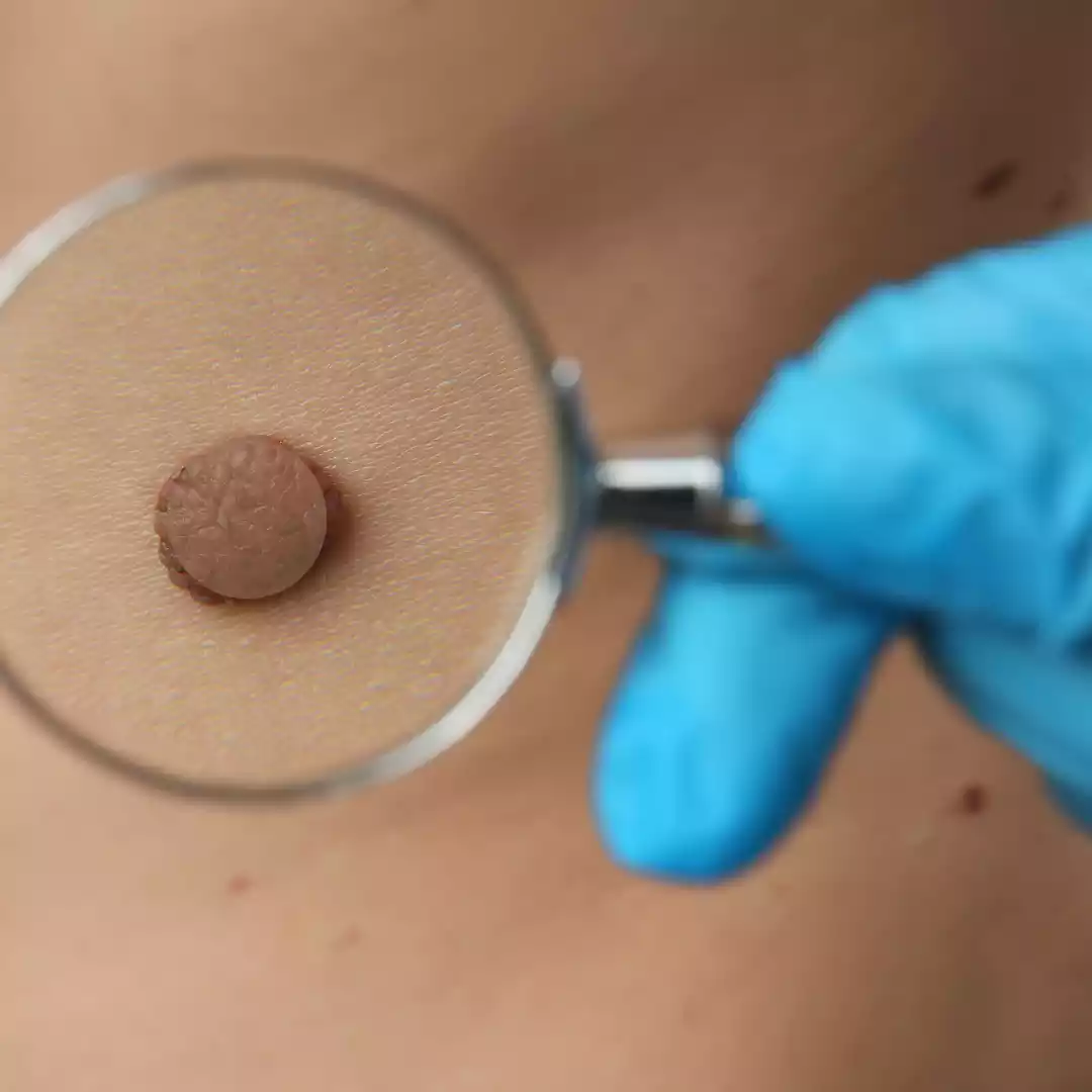 Birthmark Excision Surgery