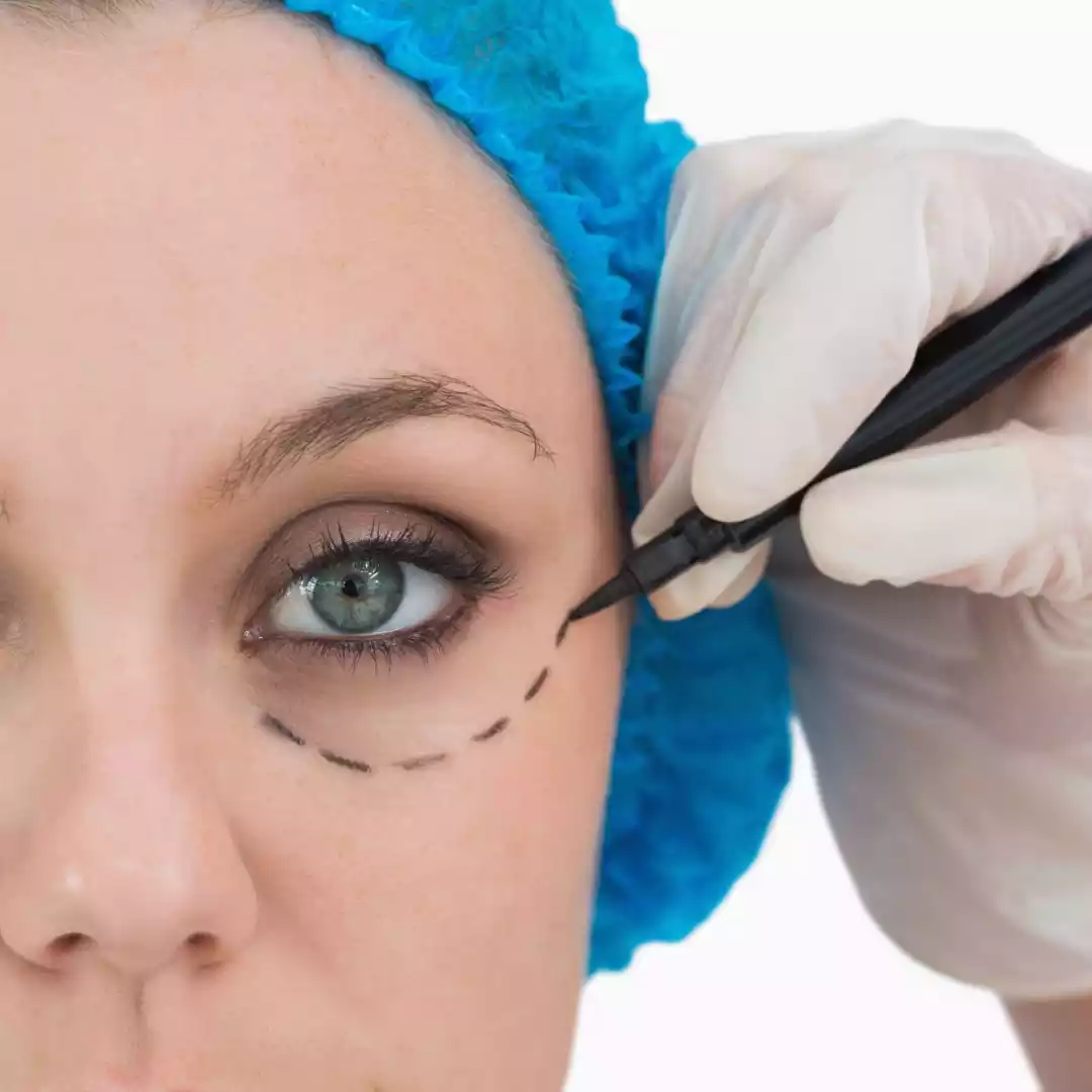 Blepharoplasty for DroopY Eyelids