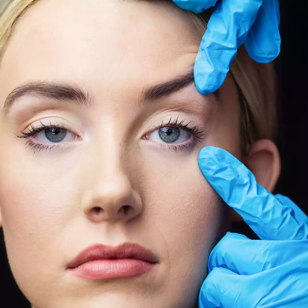 Blepharoplasty for Upper Eyelids