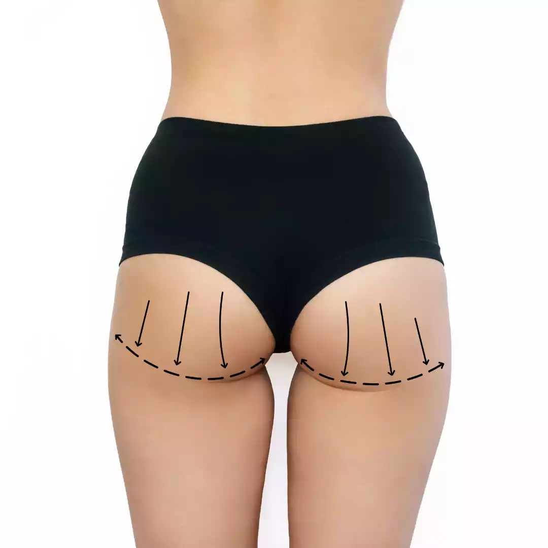 Buttock Size Correction