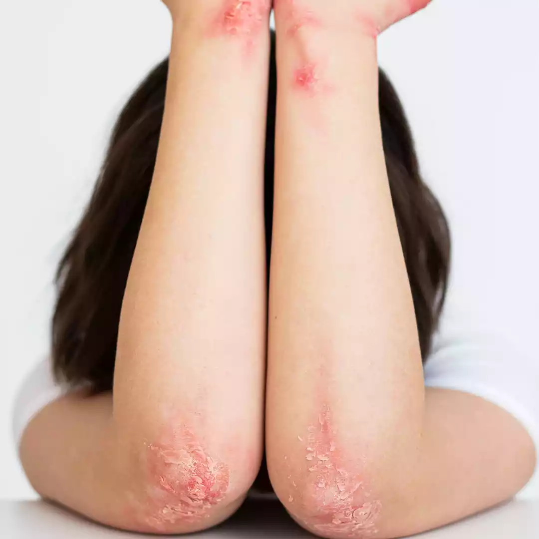 Cellulitis or Skin Infection