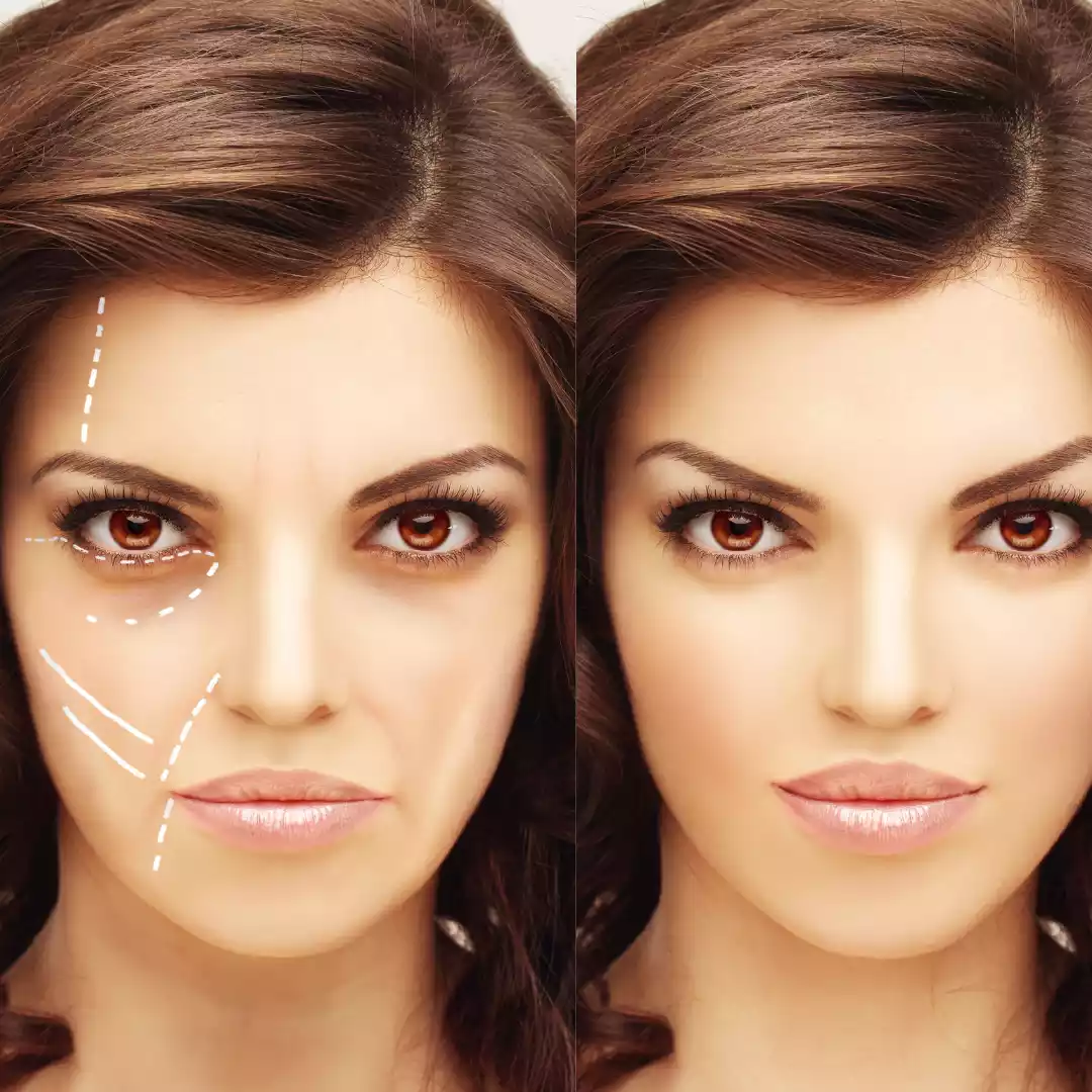Facelifts
