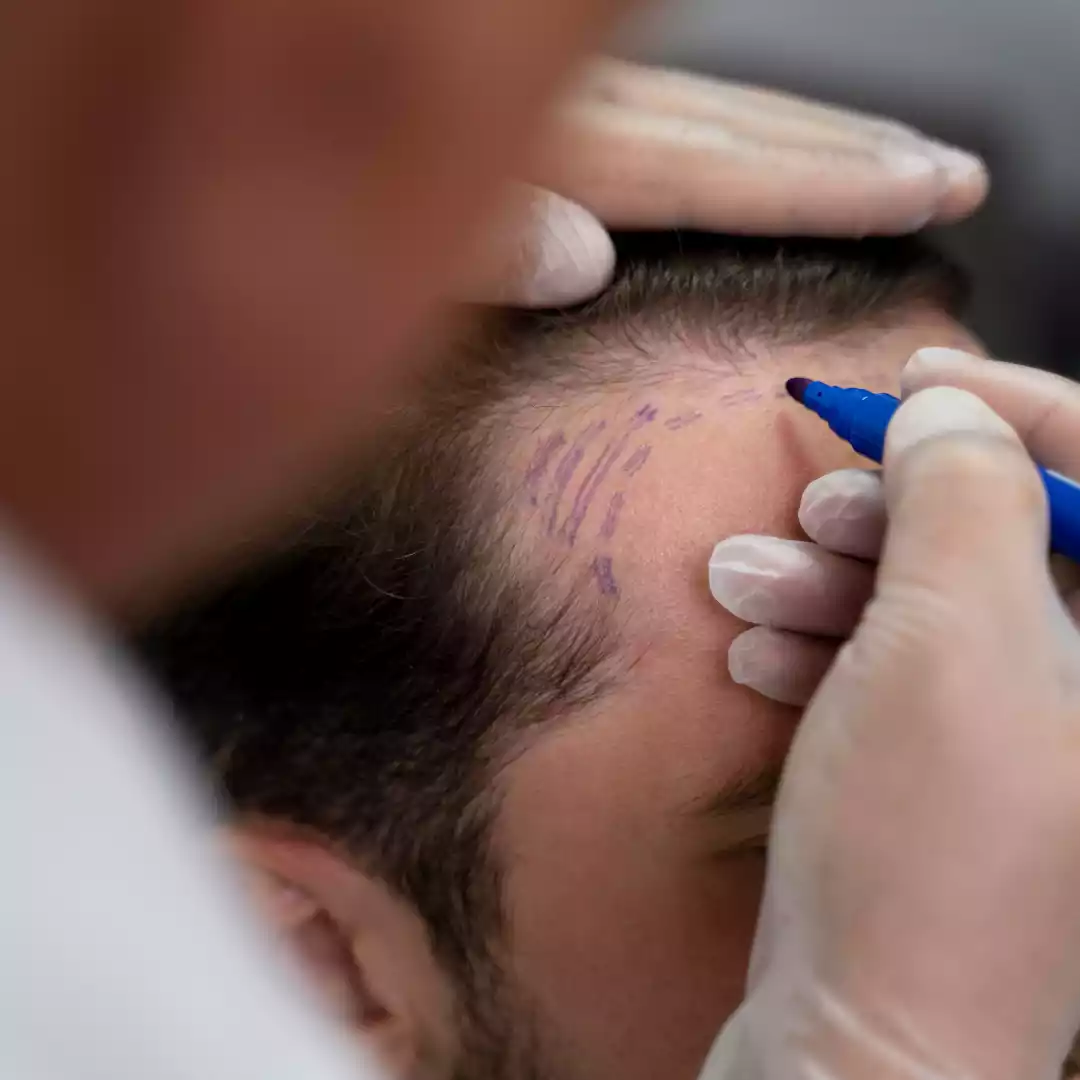 Follicular Unit Extraction (FUE)