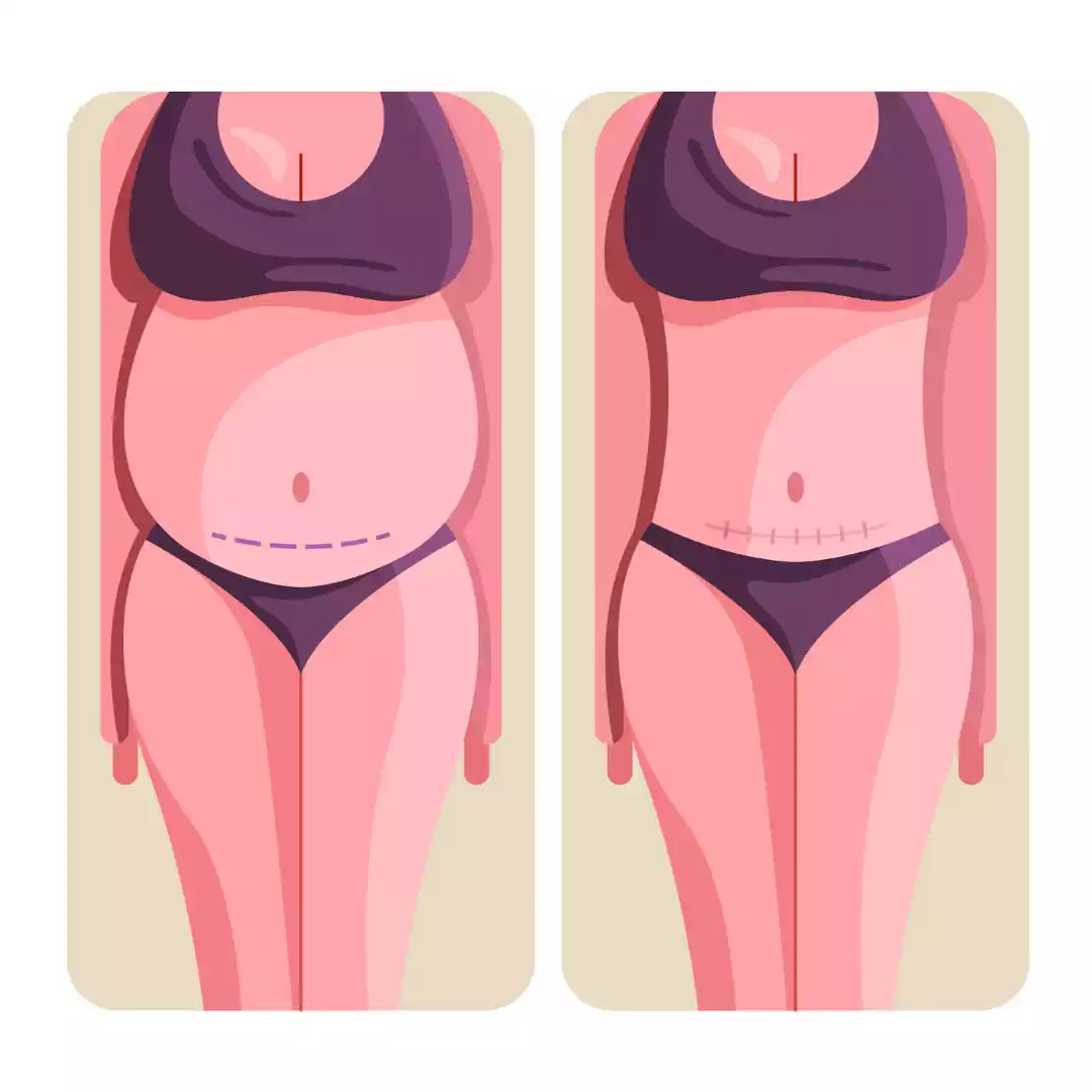 Full Tummy Tuck