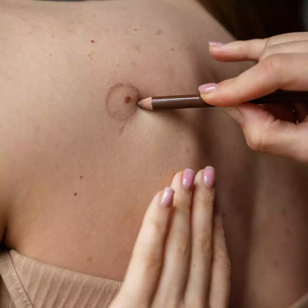 Keloid Removal Surgery