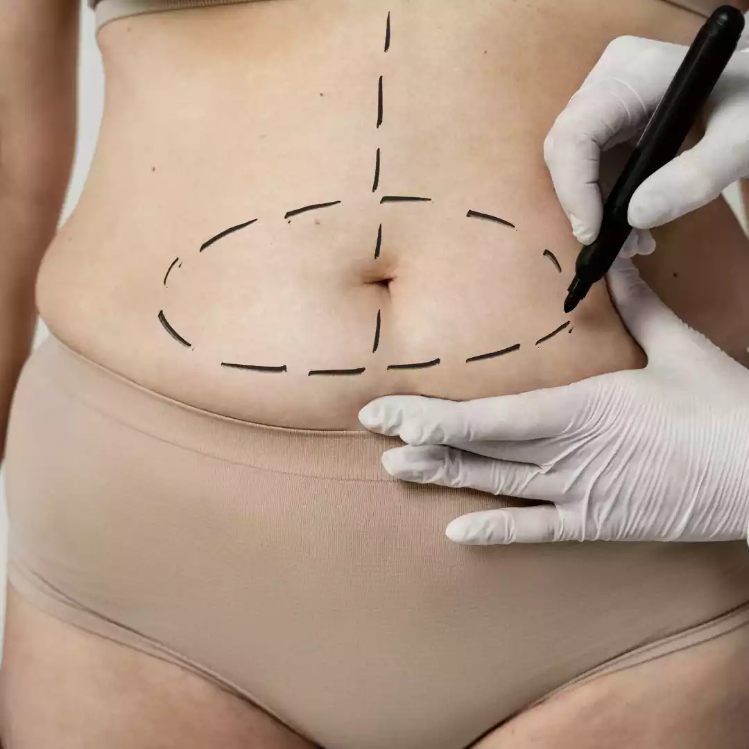 Lipoma Removal Surgery
