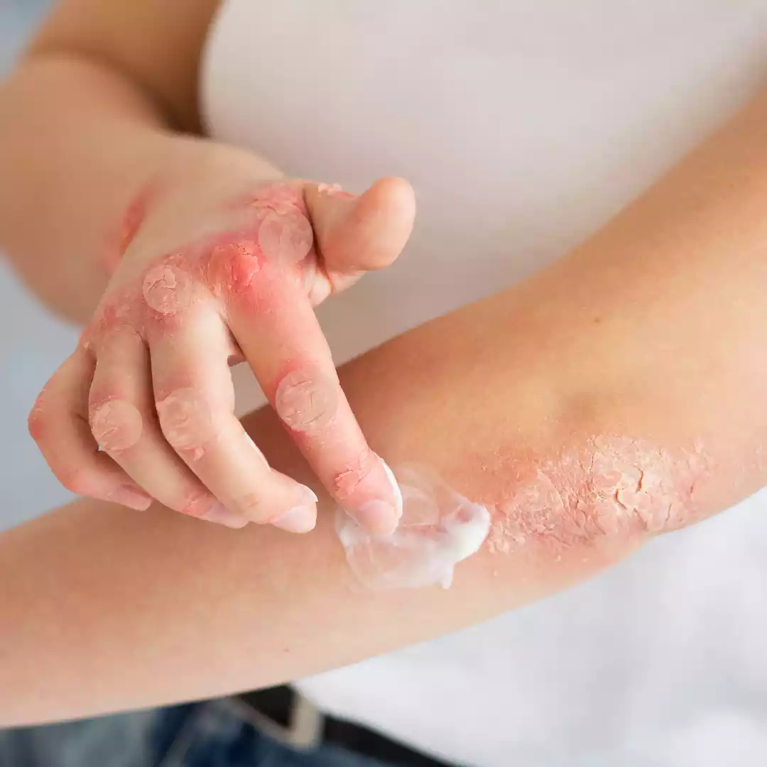 Skin Ulceration