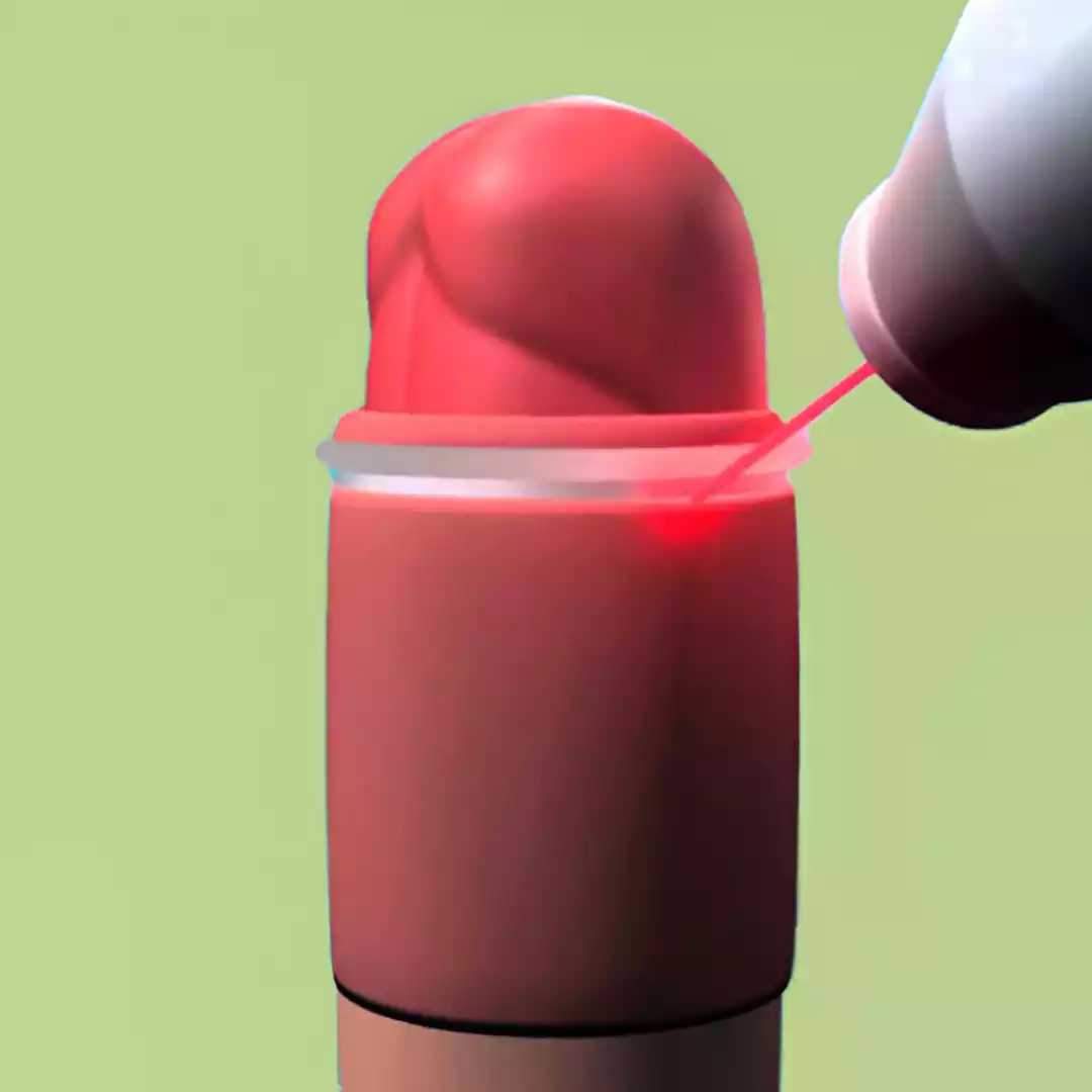 Traditional Circumcision