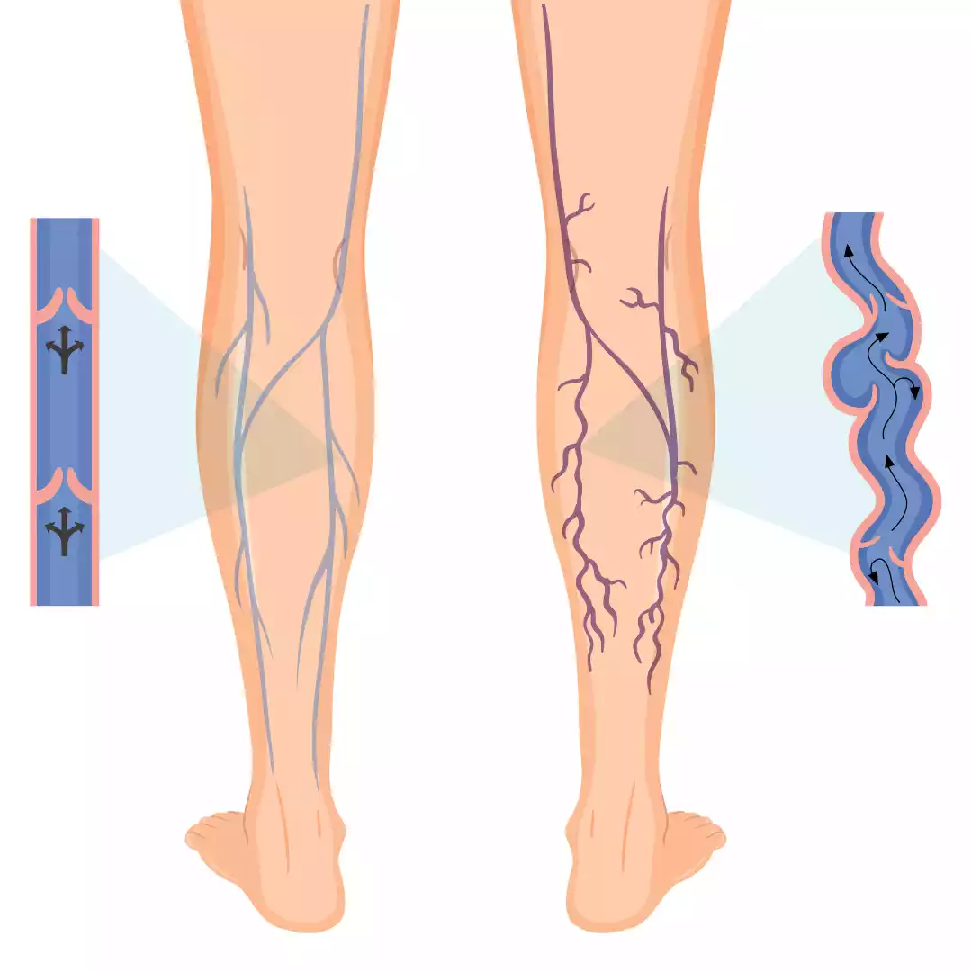 VARICOSE VEIN